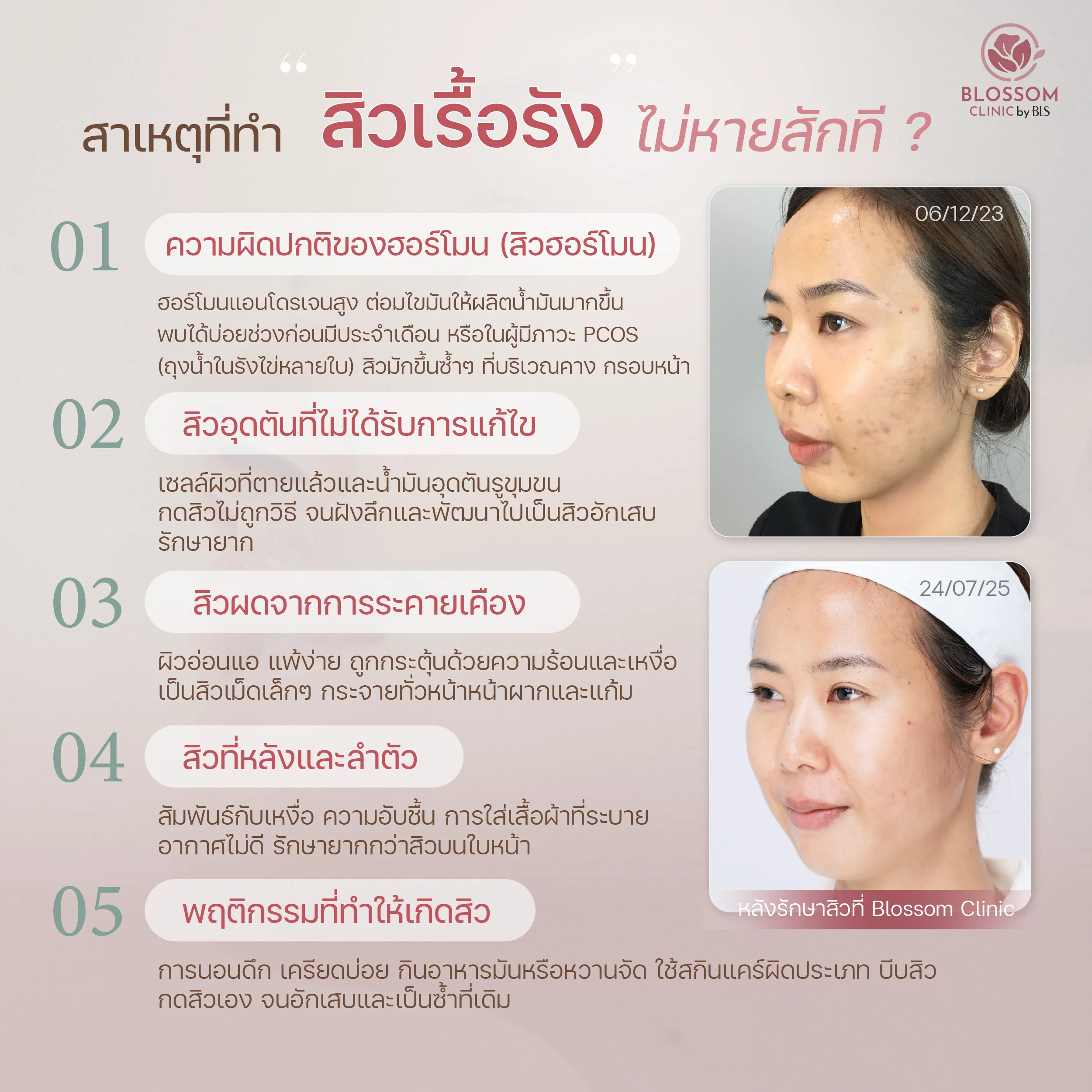 ทำไมสิวเรื้อรัง ถึงขึ้นซ้ำๆ ไม่หายสักที