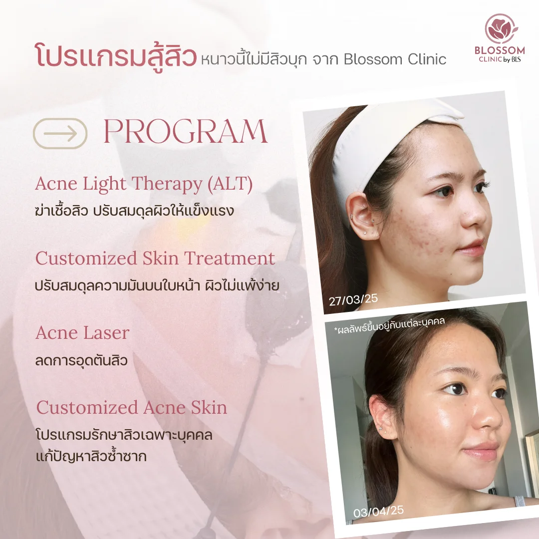 โปรแกรมสู้สิว หนาวนี้ไม่มีสิวบุก จาก Blossom Clinic