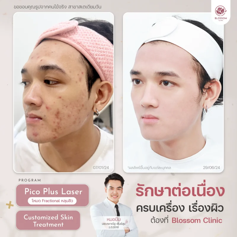 Program Customized Skin Treatment โปรแกรมดูแลผิว ออกแบบเฉพาะบุคคล