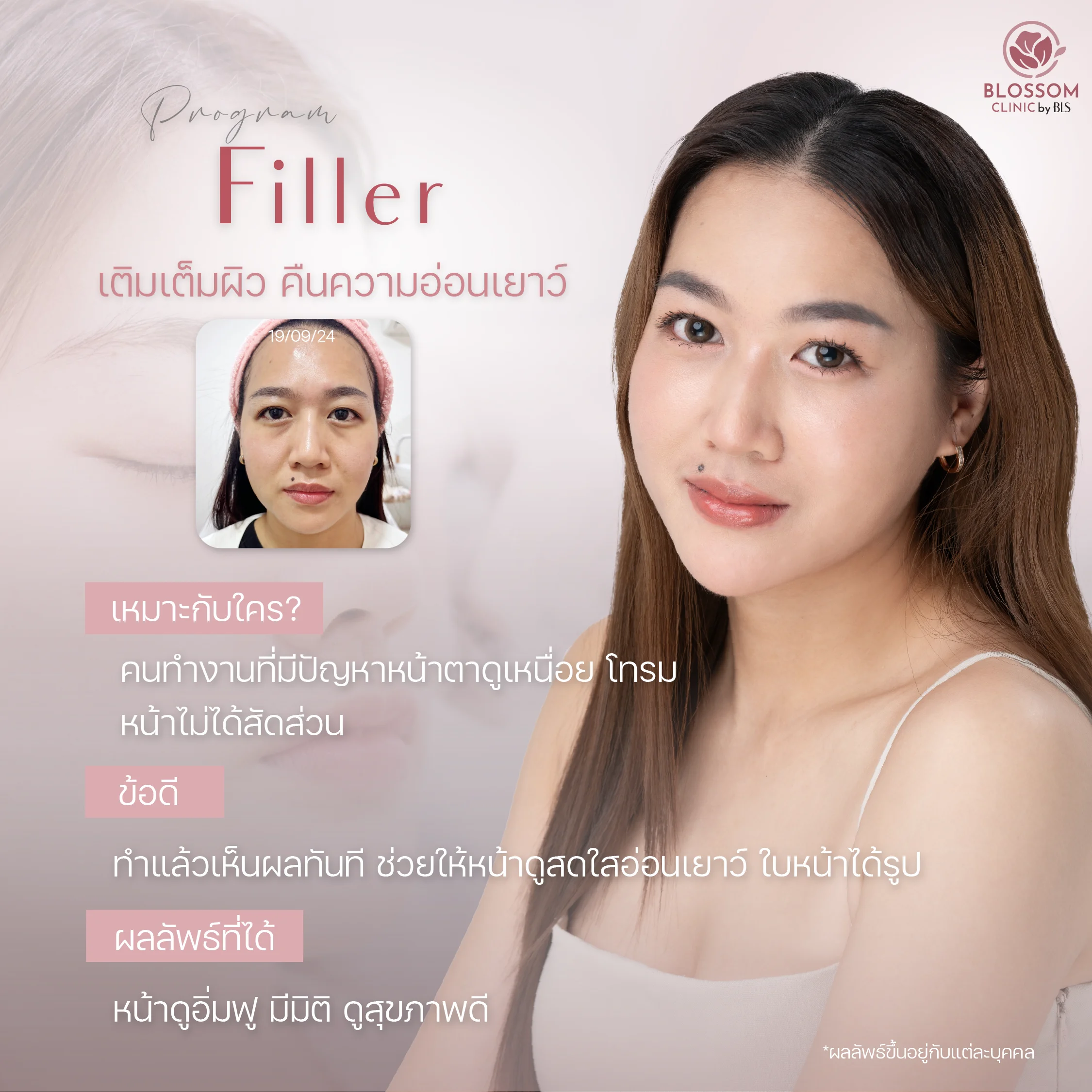 Program Filler เติมเต็มผิว คืนความอ่อนเยาว์