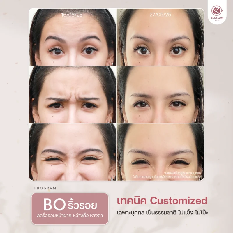 เทคนิค customized