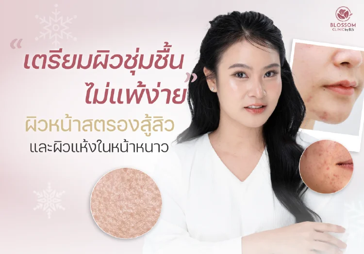 เตรียม ผิวชุ่มชื้น ไม่แพ้ง่ายผิวชุ่มชื้น ไม่แพ้ง่าย ผิวหน้าสตรองสู้สิวและผิวแห้งในหน้าหนาว