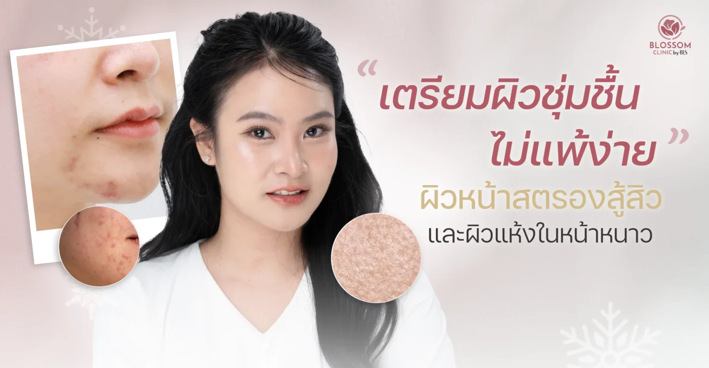เตรียม ผิวชุ่มชื้น ไม่แพ้ง่ายผิวชุ่มชื้น ไม่แพ้ง่าย ผิวหน้าสตรองสู้สิวและผิวแห้งในหน้าหนาว