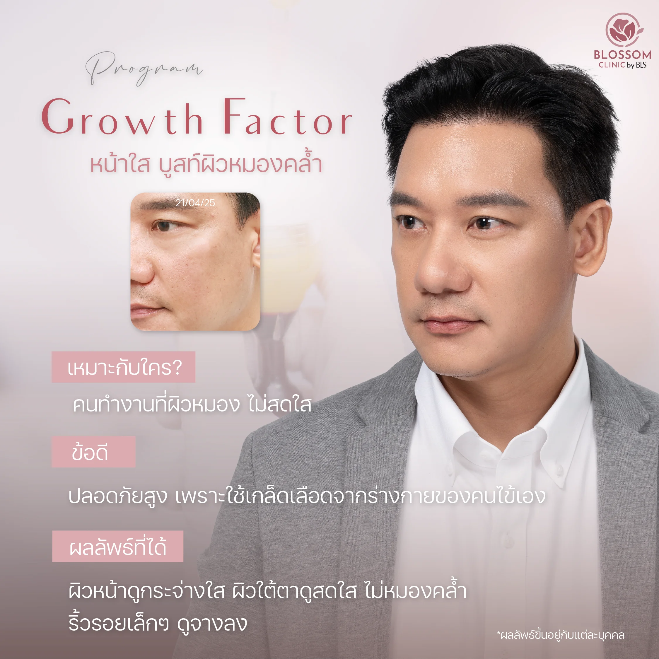 Program Growth Factor หน้าใส บูสท์ผิวใหม่ด้วยเกล็ดเลือด