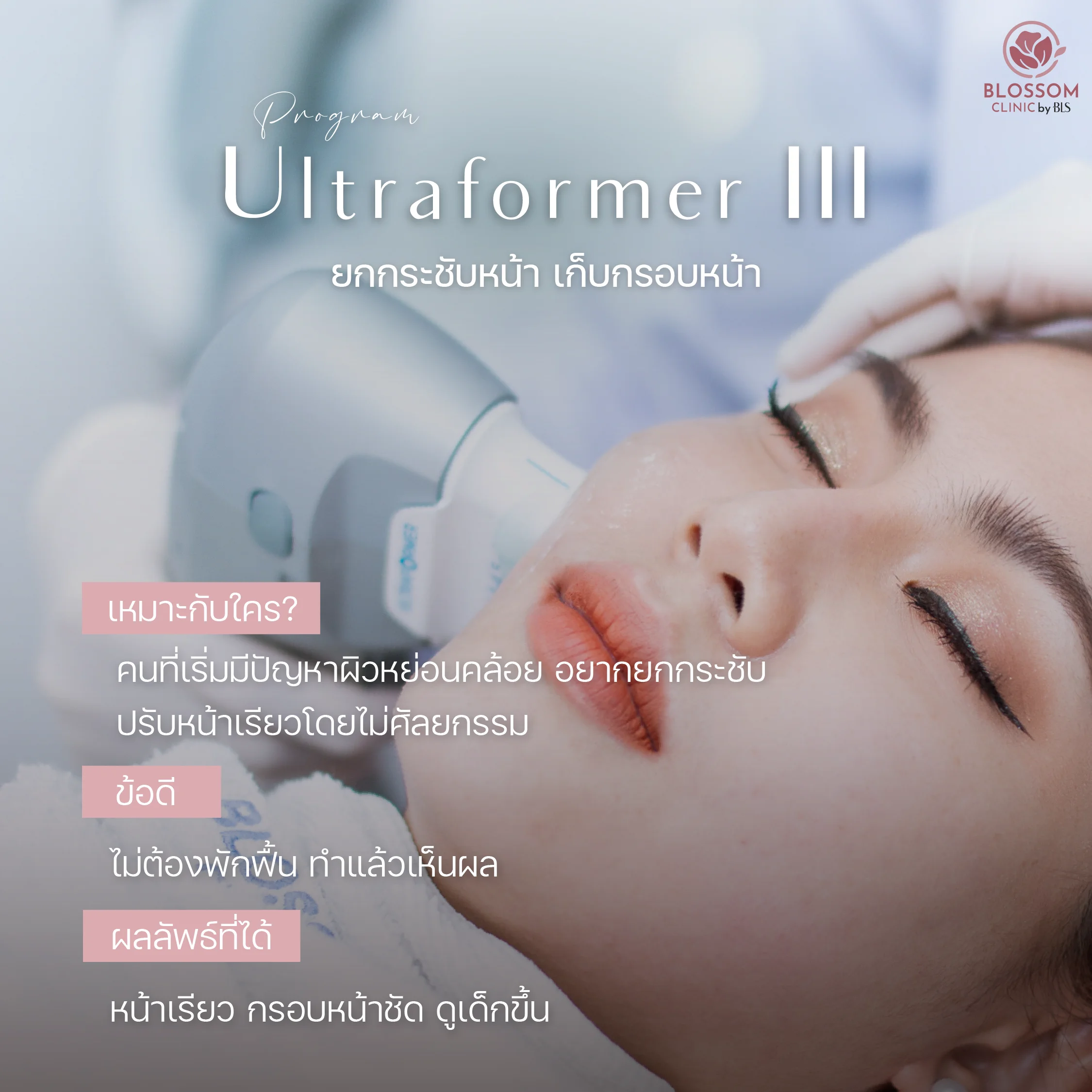 Program Ultraformer III สลายไขมัน ยกกระชับหน้า ไม่ผ่าตัด