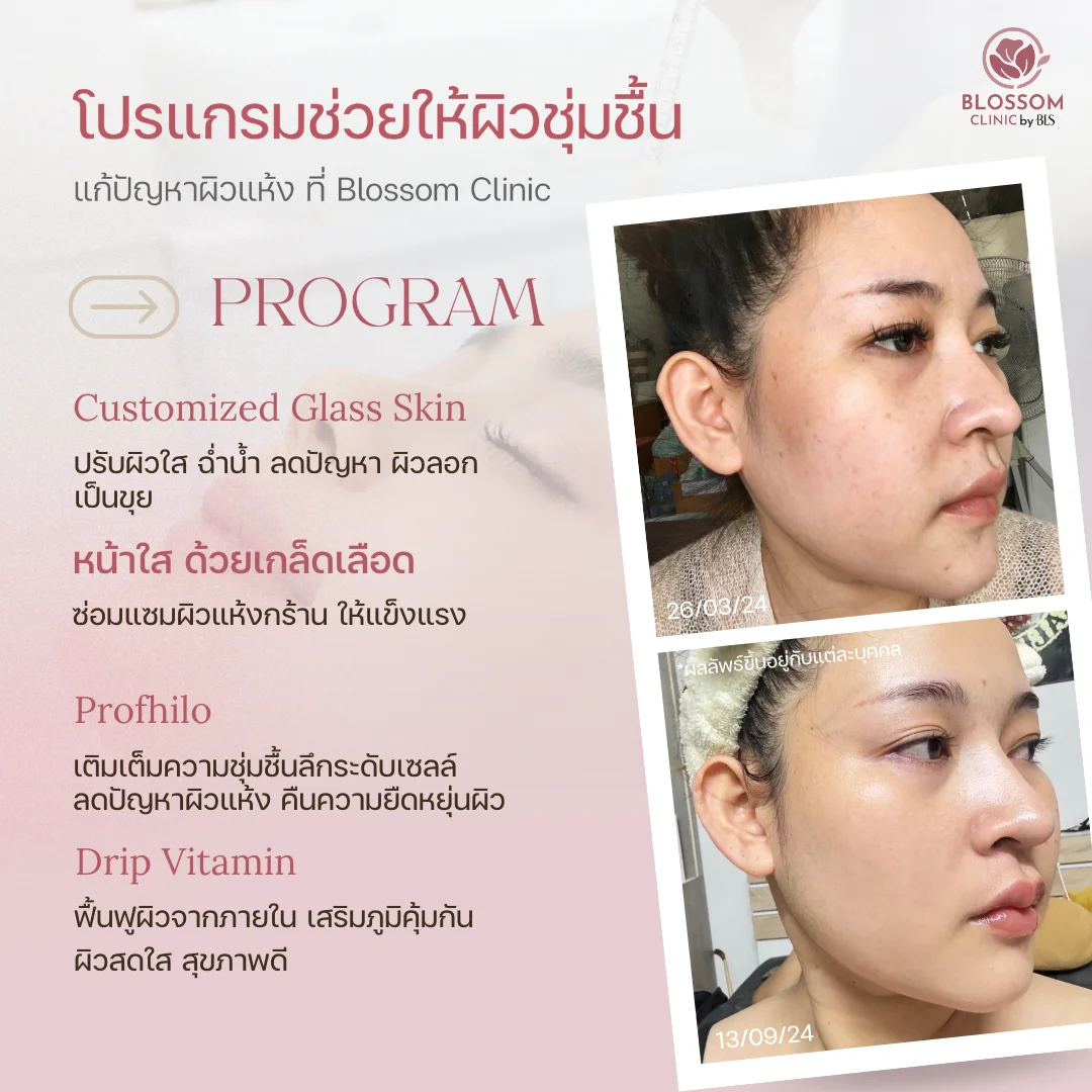 โปรแกรมช่วยให้ผิวชุ่มชื้น แก้ปัญหาผิวแห้งในหน้าหนาว