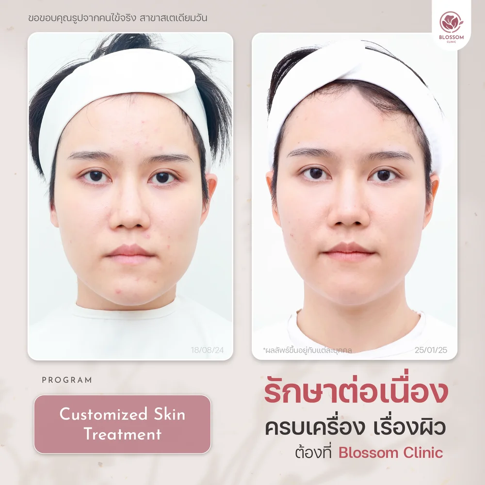 รีวิวจบปัญหาสิวเรื้อรัง เผยผิวใส ปังขั้นสุด ที่ Blossom Clinic
