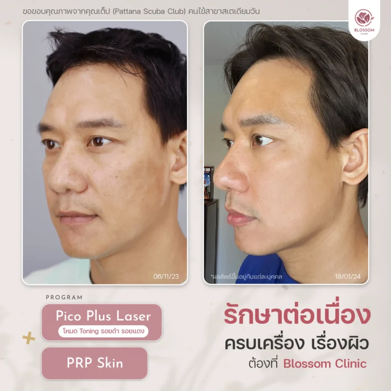 Program Growth Factor หน้าใส บูสท์ผิวใหม่ด้วยเกล็ดเลือด