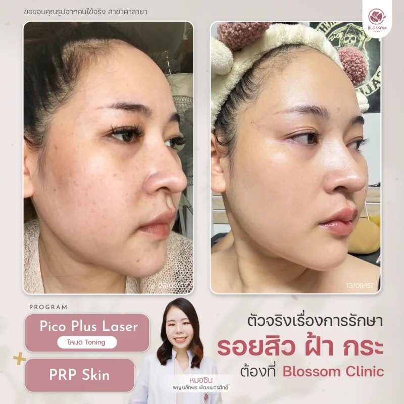 Program Growth Factor หน้าใส บูสท์ผิวใหม่ด้วยเกล็ดเลือด