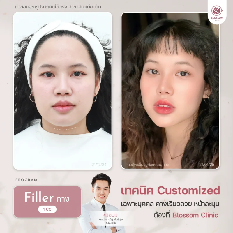 รวมเคสรีวิวผลลัพธ์สุดปัง ดูเป็นธรรมชาติ ที่ Blossom Clinic