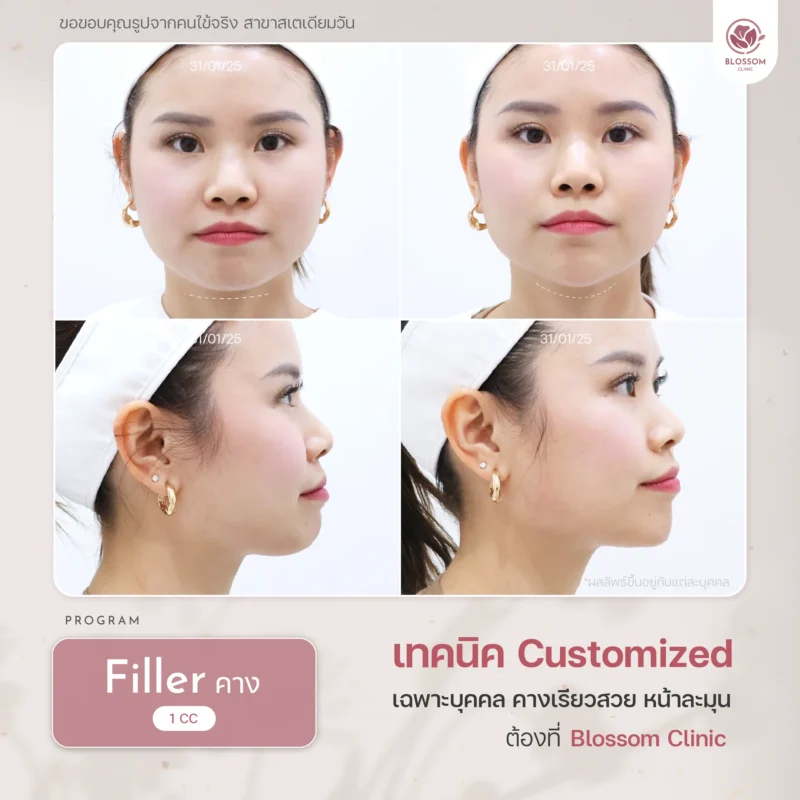 รวมเคสรีวิวผลลัพธ์สุดปัง ดูเป็นธรรมชาติ ที่ Blossom Clinic