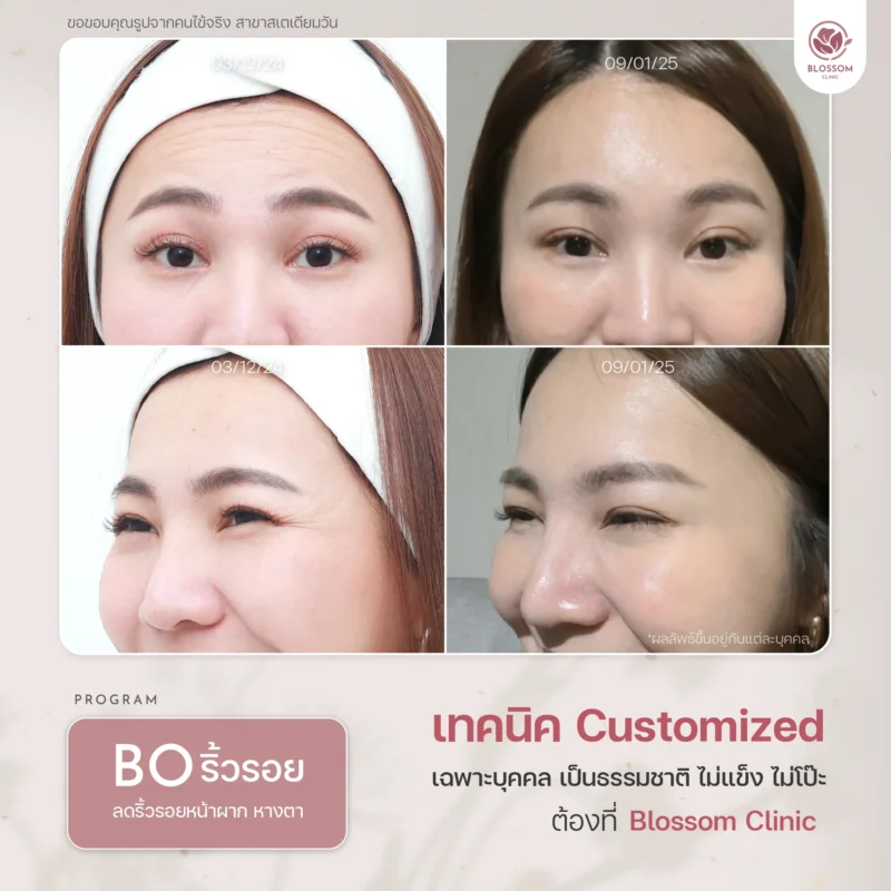 รวมเคสรีวิวผลลัพธ์สุดปัง ดูเป็นธรรมชาติ ที่ Blossom Clinic