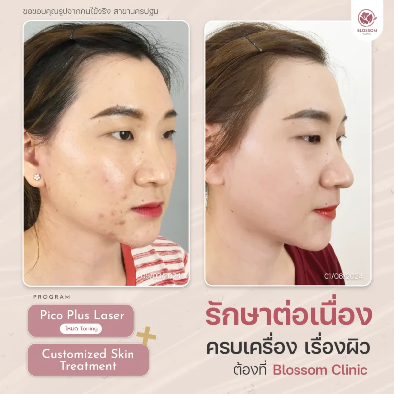 รวมเคสรีวิวผลลัพธ์สุดปัง ดูเป็นธรรมชาติ ที่ Blossom Clinic
