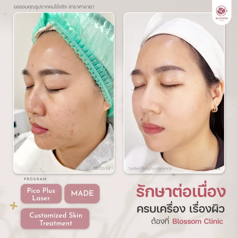 รวมเคสรีวิวผลลัพธ์สุดปัง ดูเป็นธรรมชาติ ที่ Blossom Clinic
