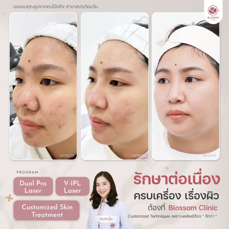 รวมเคสรีวิวผลลัพธ์สุดปัง ดูเป็นธรรมชาติ ที่ Blossom Clinic