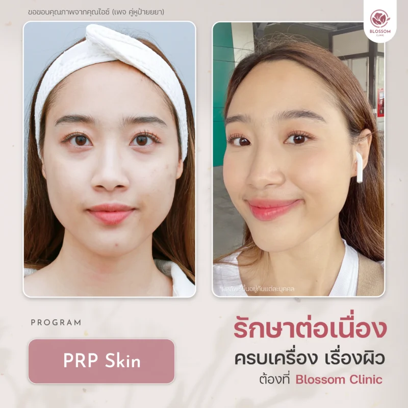 รวมเคสรีวิวผลลัพธ์สุดปัง ดูเป็นธรรมชาติ ที่ Blossom Clinic
