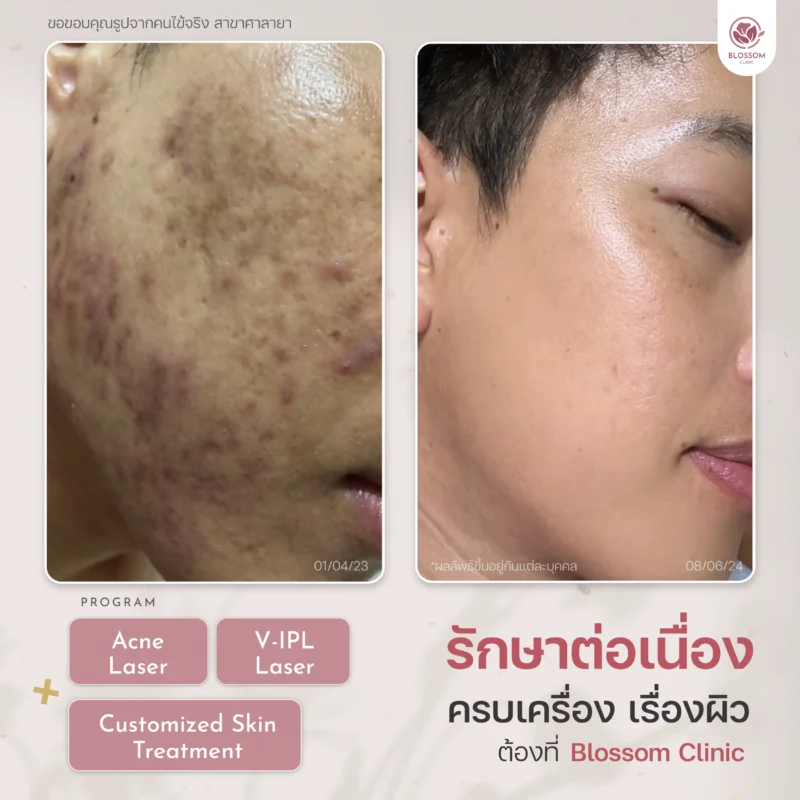 รวมเคสรีวิวผลลัพธ์สุดปัง ดูเป็นธรรมชาติ ที่ Blossom Clinic