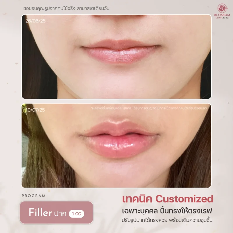 Program Filler เติมเต็มผิว คืนความอ่อนเยาว์