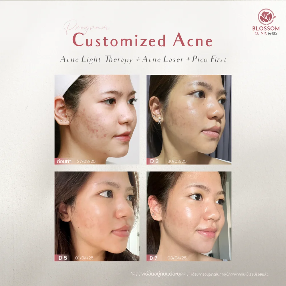 รีวิวเคสรักษาสิว ลดรอยสิว ที่ Blossom Clinic