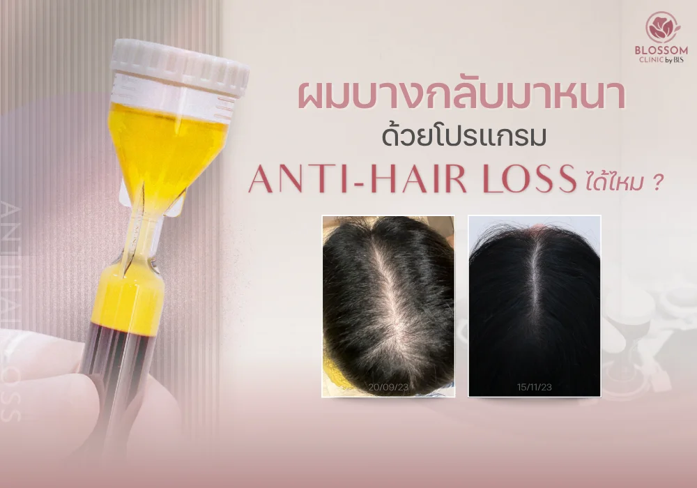 ผมบาง กลับมาหนา ด้วยโปรแกรม Anti-Hair loss ได้ไหม? โดยไม่ปลูกผม
