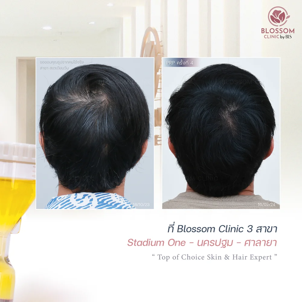 การรักษาผมบางด้วยโปรแกรม Anti-Hair loss