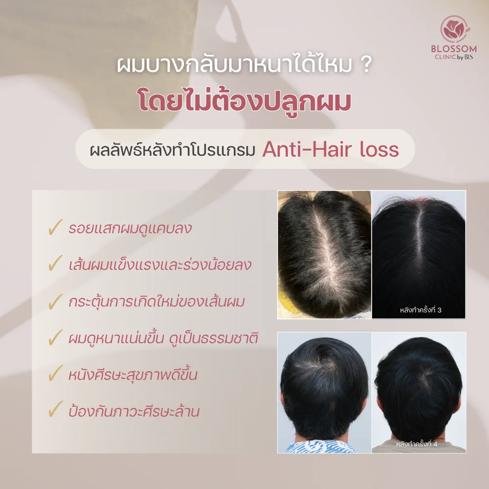 ผลลัพธ์หลังทำโปรแกรม Anti-Hair loss