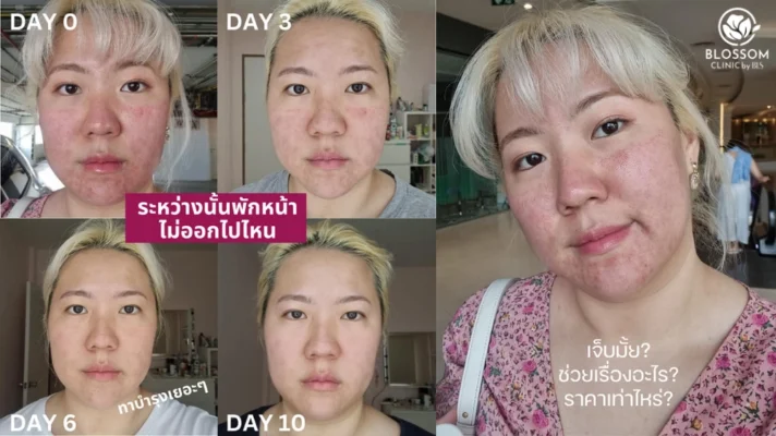 รีวิวโปรแกรม Pico Plus Laser แบบจัดเต็ม