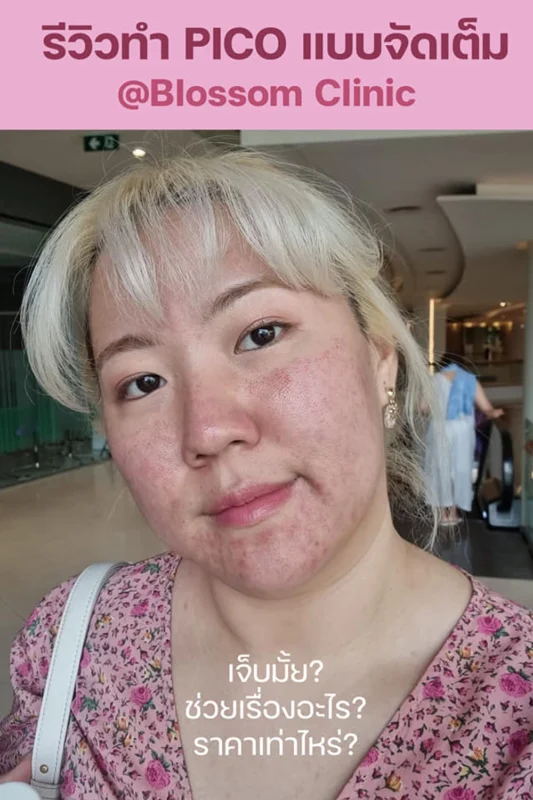 Pico Laser หลุมสิว