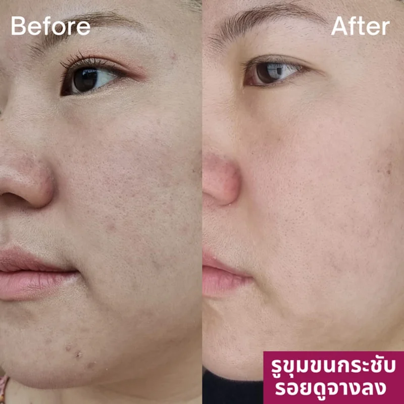 Pico ทํากี่ครั้งเห็นผล