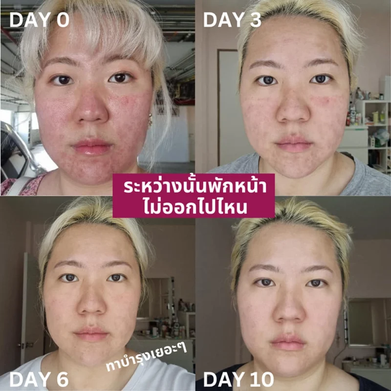 Pico Laser ช่วยอะไรได้บ้าง