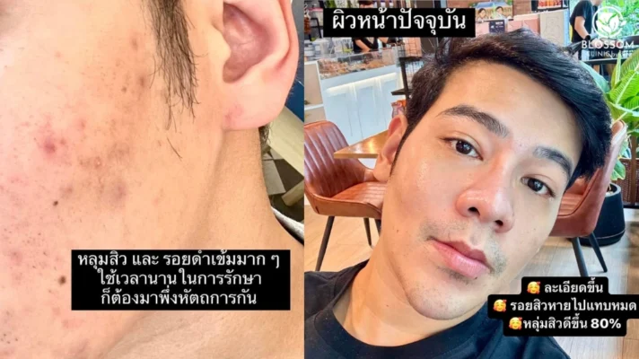 Review Program Pico Laser Maintain มา 2 ปีเป็นอย่างไรบ้าง?