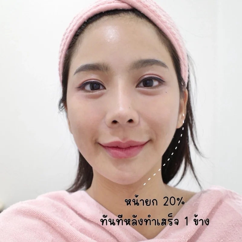 เลเซอร์ควรพักหน้ากี่วัน