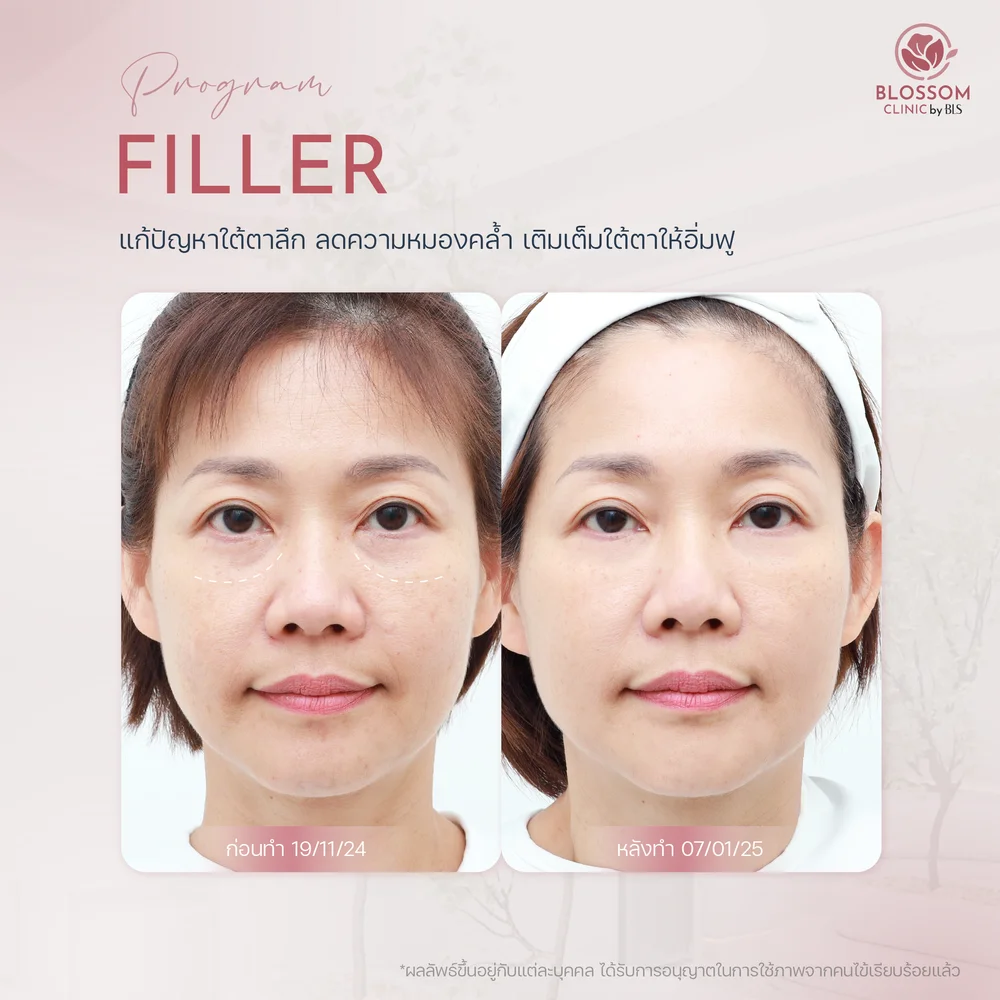 รีวิวเคสทำโปรแกรม Filler ใต้ตา ที่ Blossom Clinic