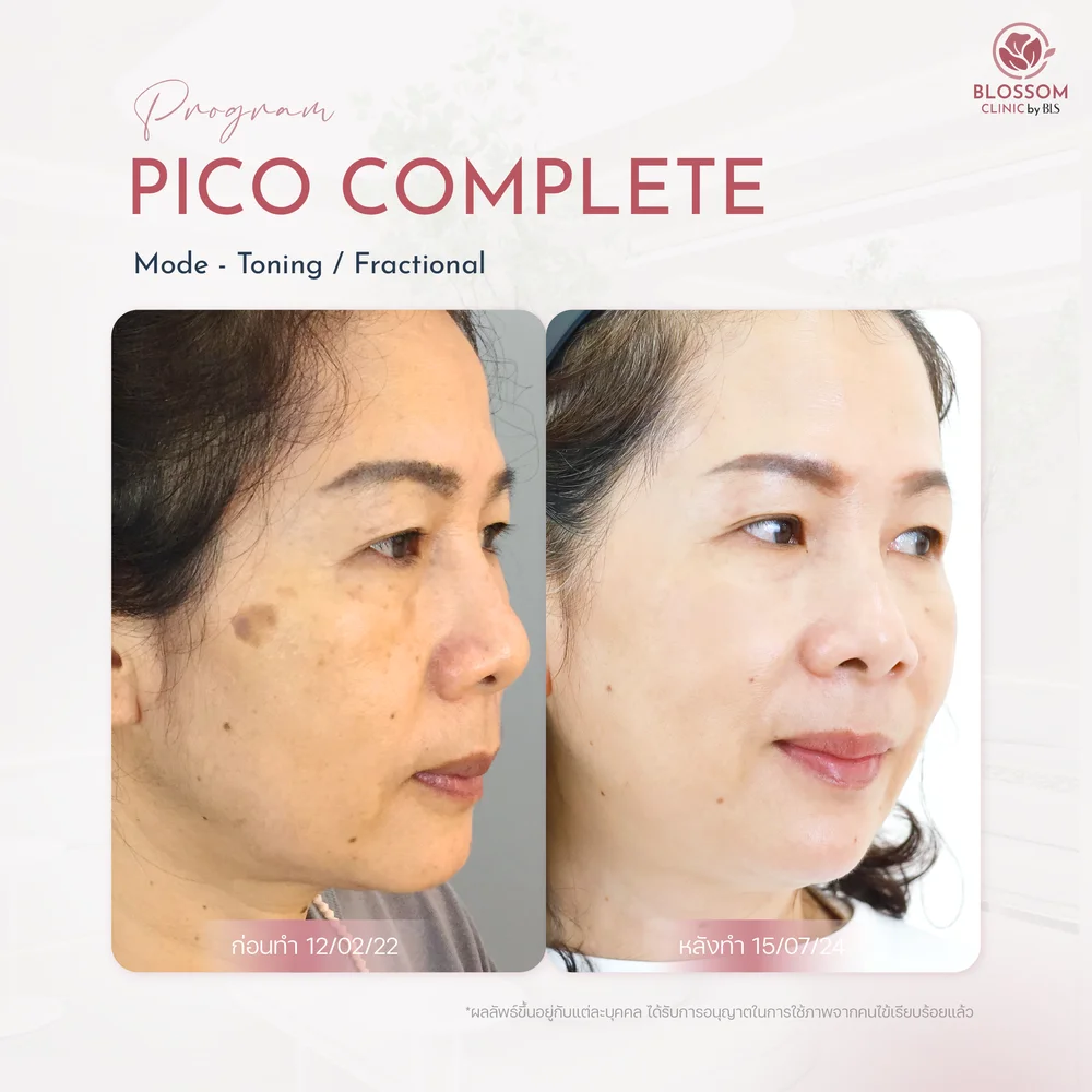 รีวิวเคสทำโปรแกรม Pico Complete ที่ Blossom Clinic