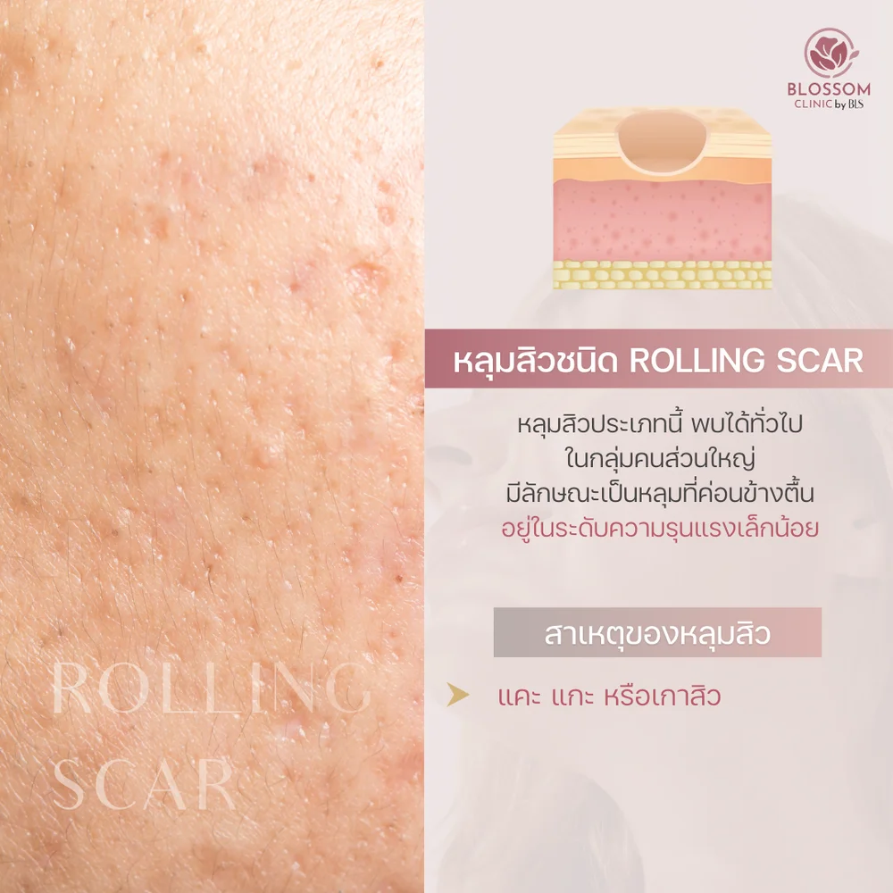 หลุมสิวแบบ Rolling Scar