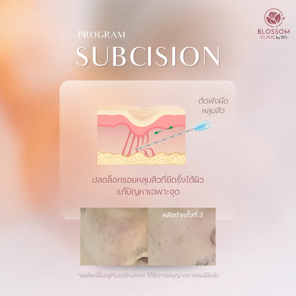 โปรแกรม Subcision - ตัดพังผืดหลุมสิว สำหรับเคสหลุมลึกพังผืดยึดรั้ง