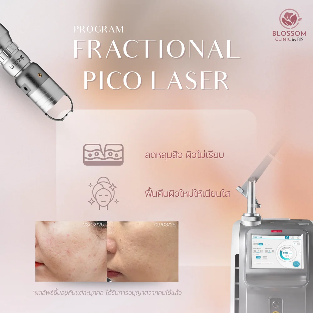 ปัญหา หลุมสิว รักษาด้วยโปรแกรม Pico Laser