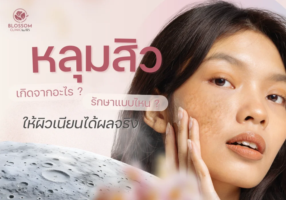หลุมสิวเกิดจากอะไร? รักษาแบบไหน? ให้ผิวเนียนได้ผลจริง