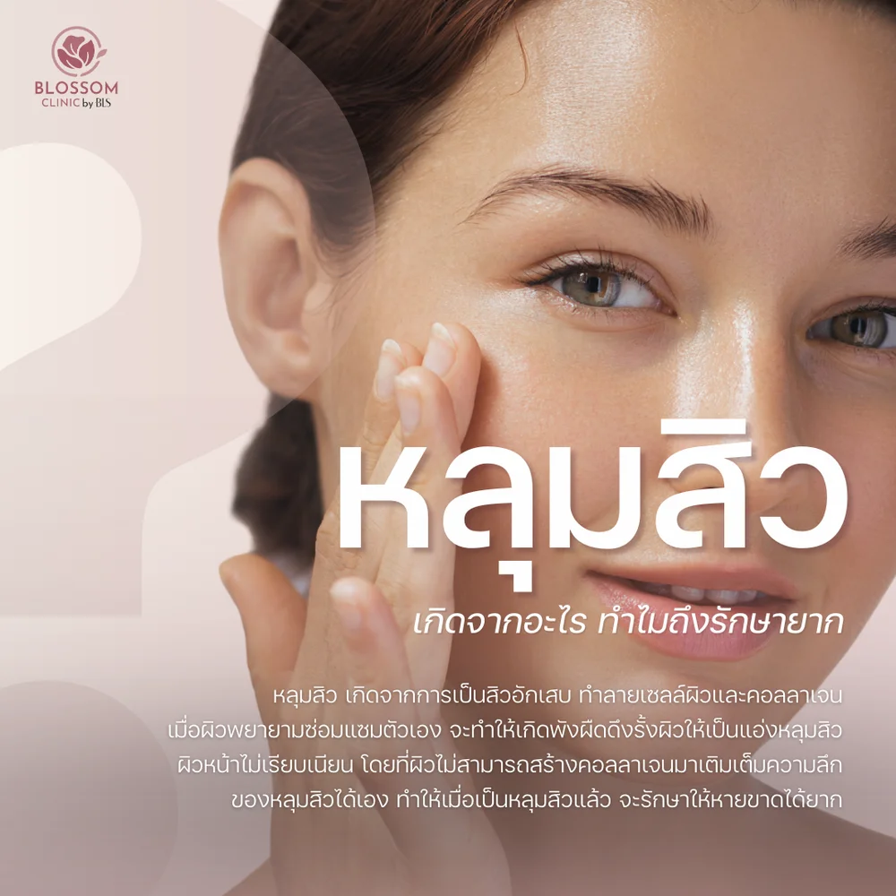 หลุมสิวแบบ Icepick Scar