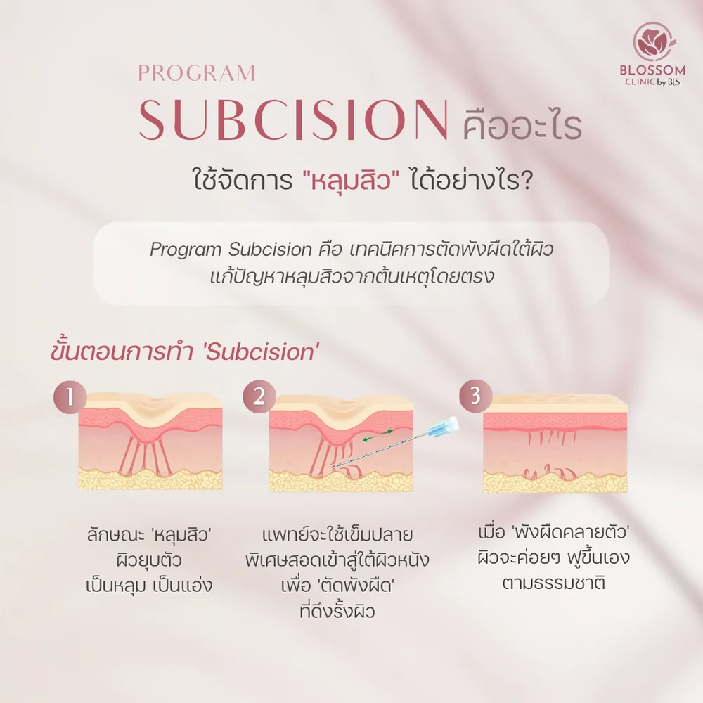 โปรแกรม Subcision คืออะไร