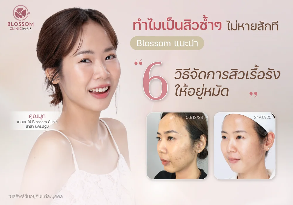 ทำไมเป็นสิวซ้ำๆ ไม่หายสักที?
รวมวิธีจัดการ สิวเรื้อรังให้อยู่หมัด