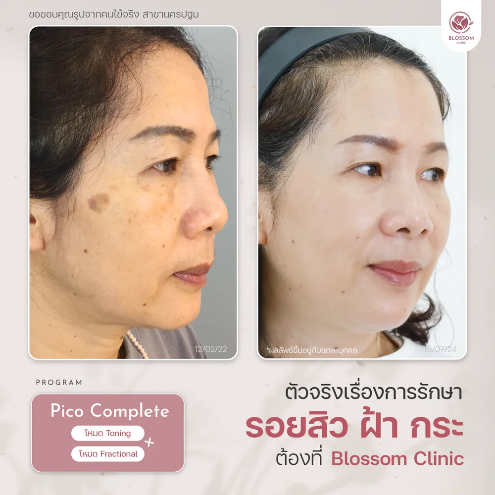 Program Pico Plus Laser เหมาะกับปัญหาผิวแบบไหนบ้าง