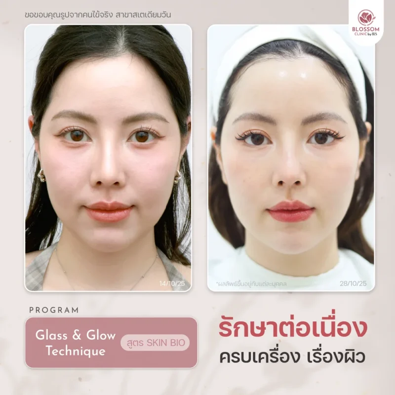 รีวิวโปรแกรมดูแลผิวและเส้นผม ที่ Blossom Clinic by BLS
