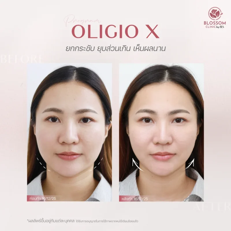 รีวิวโปรแกรมดูแลผิวและเส้นผม ที่ Blossom Clinic by BLS