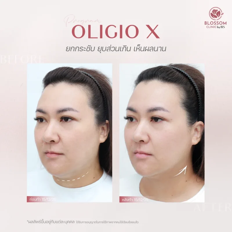 รีวิวโปรแกรมดูแลผิวและเส้นผม ที่ Blossom Clinic by BLS