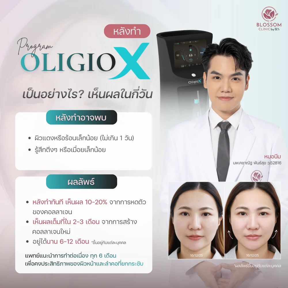 โปรแกรม Oligio X ใช้กี่ครั้งถึงเห็นผลและอยู่ได้นานแค่ไหน