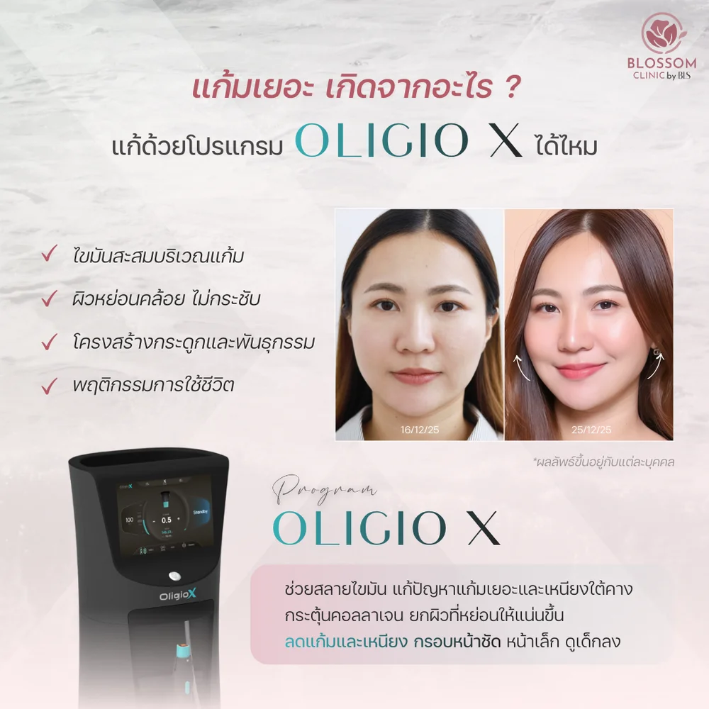 โปรแกรม Oligio X ช่วยอะไร เห็นผลกี่วัน