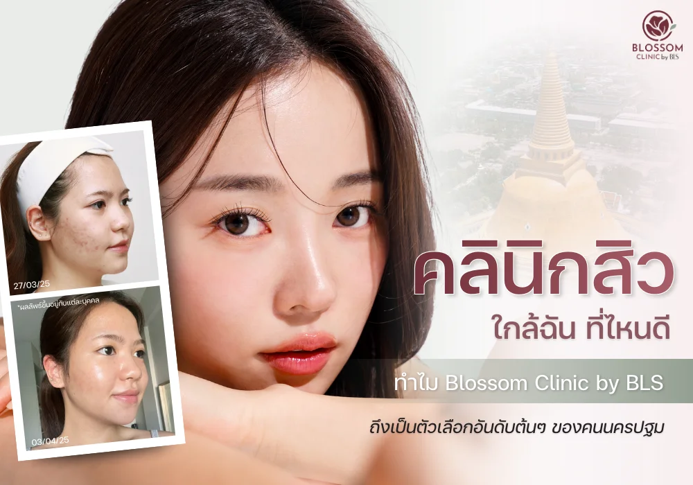 คลินิกสิวใกล้ฉัน ที่ไหนดี? ทำไม Blossom Clinic by BLS ถึงเป็นตัวเลือกของคนในนครปฐม