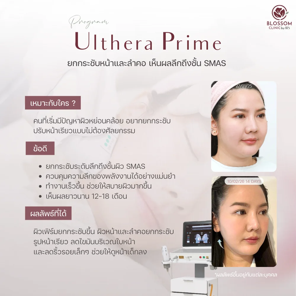 Ulthera Prime เหมาะกับใคร มีประโยชน์อะไรบ้างสำหรับผิวหน้า