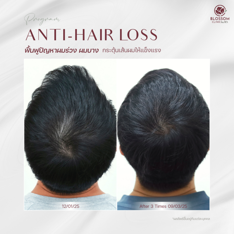 รีวิวโปรแกรม Anti-Hair Loss